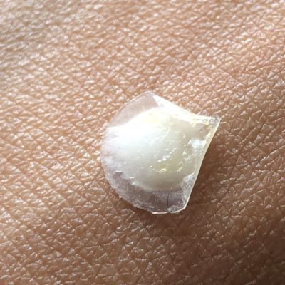 The Pimple Patches That Heal Zits Overnight - Beauty Barn Blog