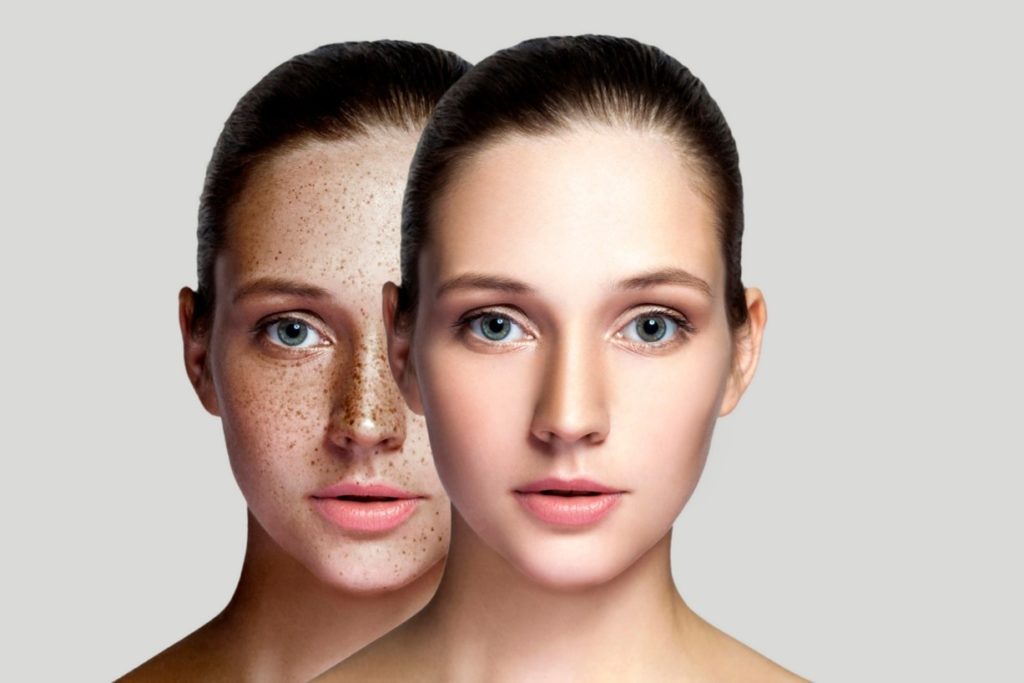 2faces of the same girl, the one behind with dark spots, hyperpigmentation and uneven skin tone and the one in the front with clear, bright, even-toned skin