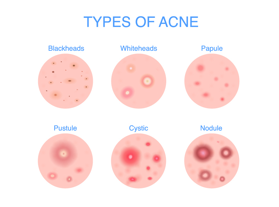 Types of Acne - Best k-beauty ingredients for acne