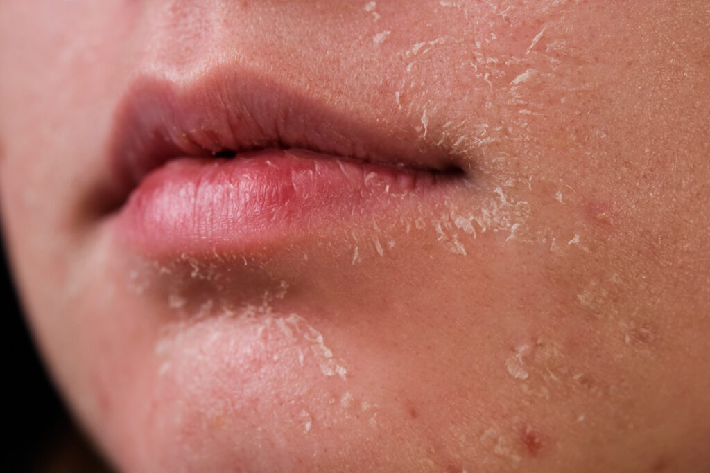 image showing dry and flaky skin