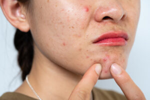 image showing acne scars
