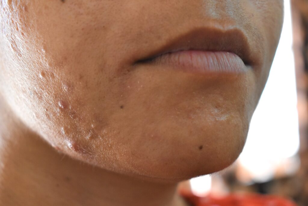 image showing female with acne